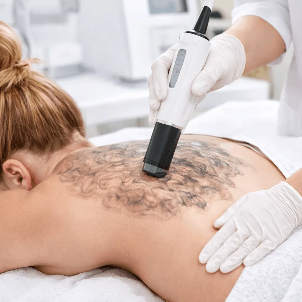Tratamiento anti-acné de espalda