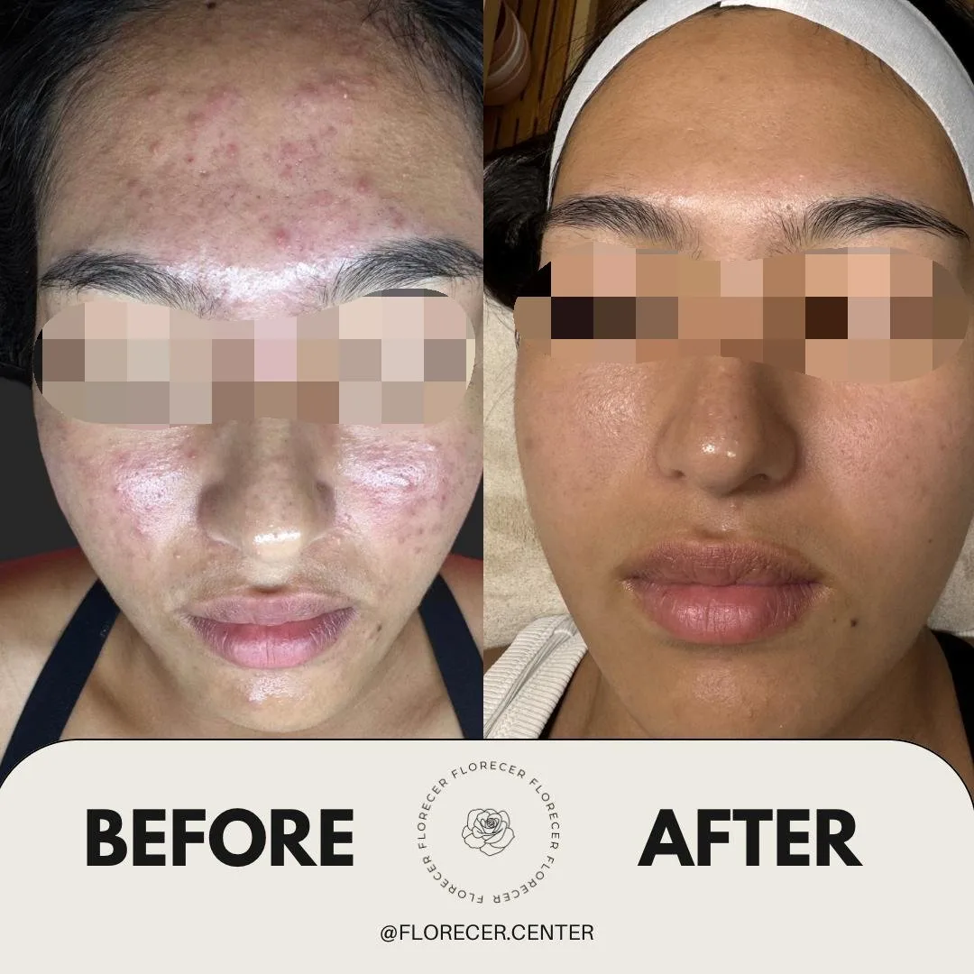 Resultado facial antes y después 1