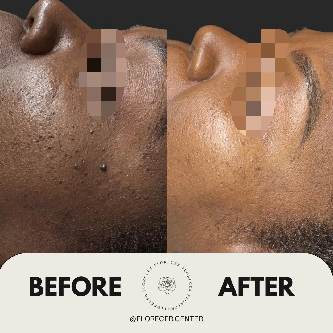 Resultado dermatosis papulosa nigra plasma fibroblast