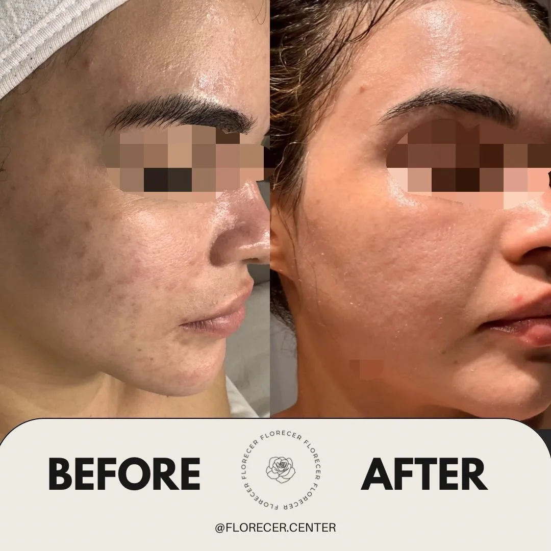 Resultado facial 13 días 1