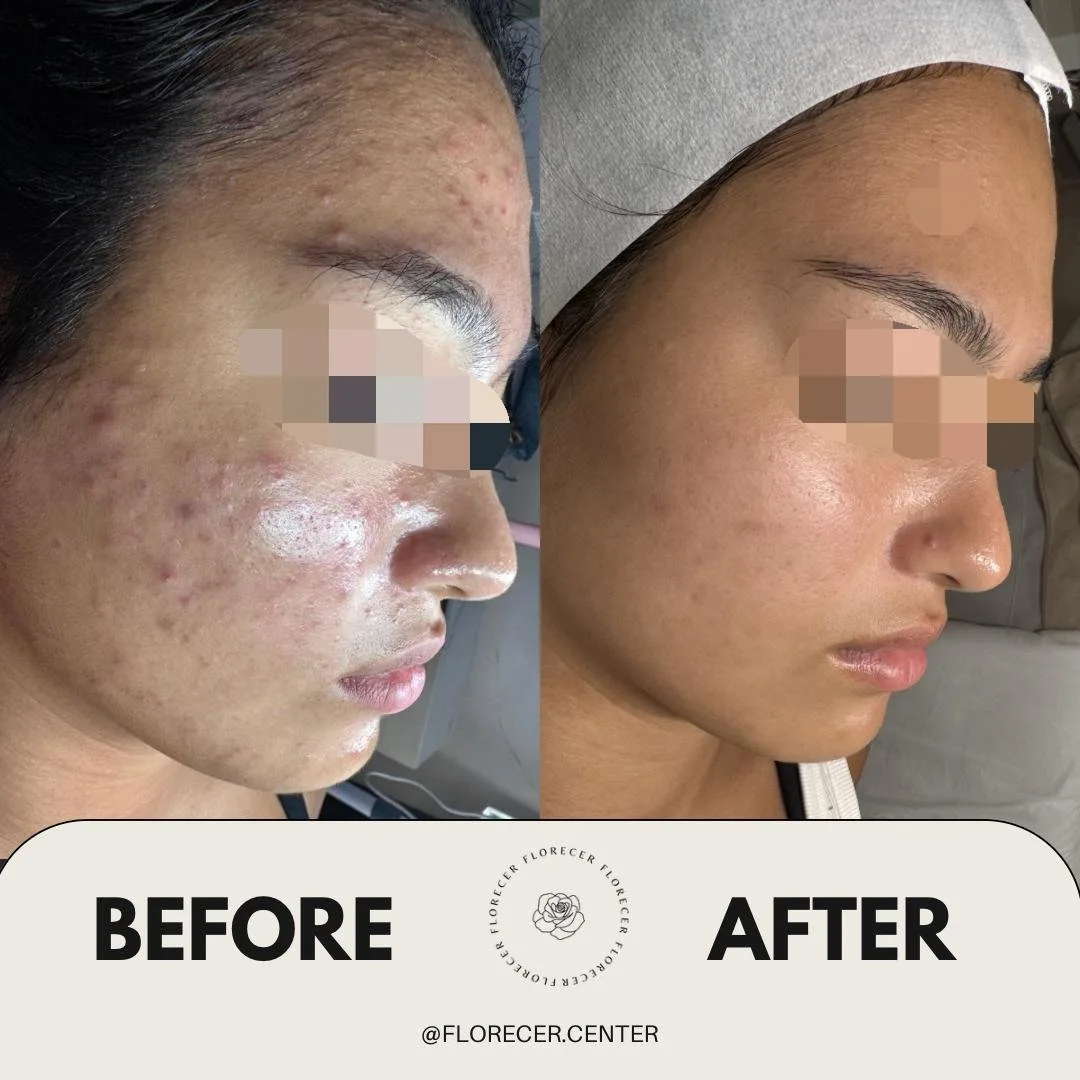 Resultado facial antes y después 2