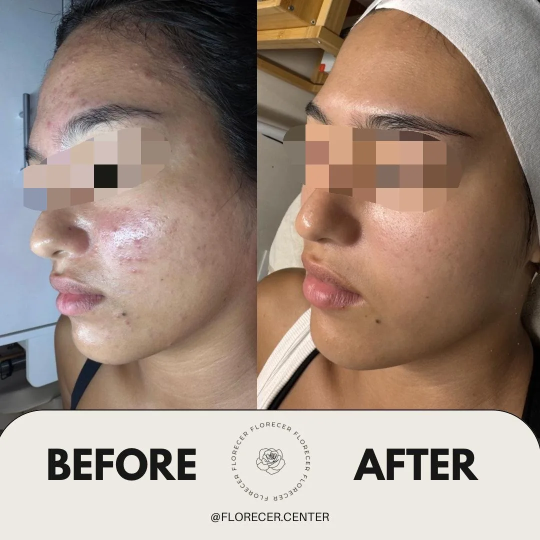 Resultado facial antes y después 3