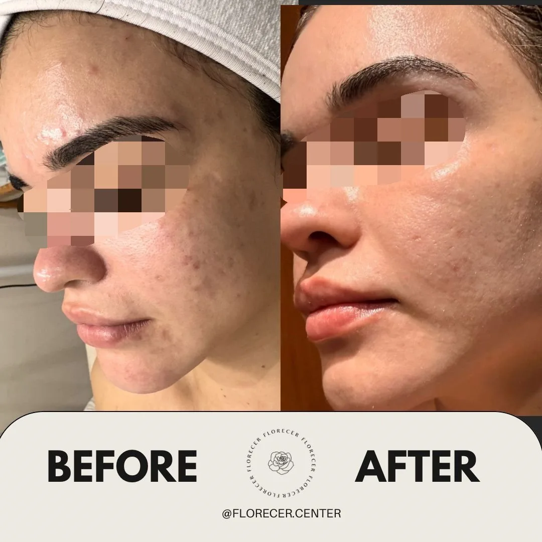 Resultado facial 13 días 2